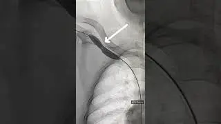 Cephalic vein Stenosis. Balloon Angioplasty of stenosis. Interventional Radiology. #iRad #dialysis