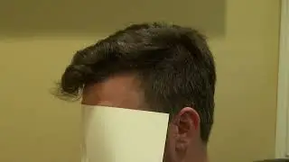 Before and After FUE Hair Transplant Results by Dr. Diep in Los Gatos, CA.