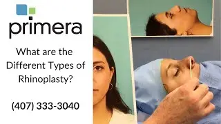What are the Different Types of Rhinoplasty Surgery?