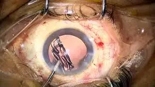Live Cataract Surgery: Femto Technique with TECNIS Eyhance IOL