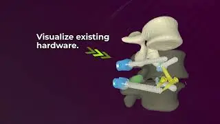 SyncAR® Spine | XR Visualization Across the Entire Spine Surgery Workflow