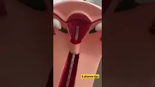 IUD Insertion #S pharma tips shorts.