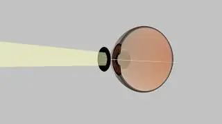 Pinhole Occluder Use in Visual Acuity Testing