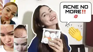 Beautederm Review | Best Acne Skincare 2019 | Korean Glass Skin