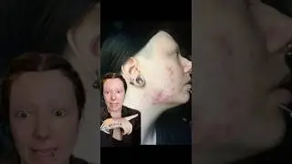 Как я вылечила гормональные прыщи #уходзакожей #лечениепрыщей