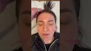 🤧ЛУЧШИЕ ТОЧКИ АКУПУНКТУРЫ ДЛЯ ЛЕЧЕНИЯ ГАЙМОНИТА #ТОЧКИАКУПУНКТУРЫ