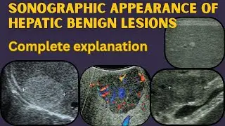 Sonographic appearance of Hepatic benign tumers | Radiology cases tutorial