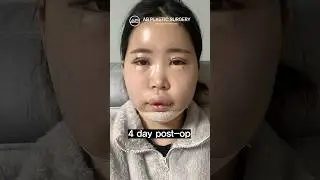 Facial contouring+Double eyelid surgery #koreanplasticsurgery