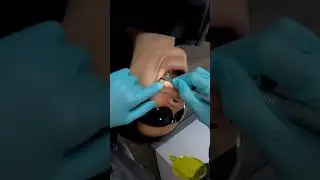 Removing Patient's Attachments! | Invisalign and Braces Orthodontist | Houston, TX