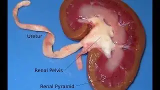 coagulative necrosis kidney gross and microscopic features for medical students