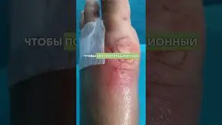 У нее был сильный отек после грации на стопе. Что делать?