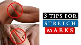 How to get rid of STRETCH MARKS on your SHOULDERS, LEGS & STOMACH