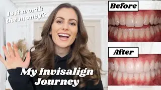 INVISALIGN JOURNEY | Before & After - Is it worth it?