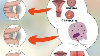 laxit&eacute; vaginal, tout saw dwe konnen de resere vajen,vajen an pa dwe fl&ograve;p. ( Bichelton Terlius)