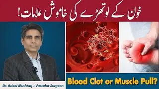How to Spot a Blood Clot in Your Leg | Treatment Of Blood Clot | Tangon Mein Khoon Jamne Ki Nishani