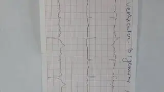 ventricular bigeminy and trigeminy