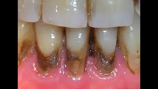 Es sarro, NO ES CARIES 