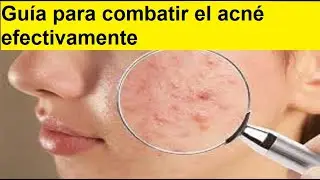 Gu&iacute;a para combatir el acn&eacute; efectivamente
