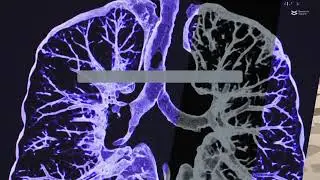 Time, host, and body compartment specific viral dynamics after lung transplantation