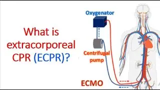 What is extracorporeal CPR (ECPR)?