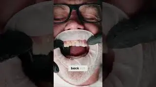 Prepless Veneers Transformation  | Dr. Field | Peninsula Center of Cosmetic Dentistry