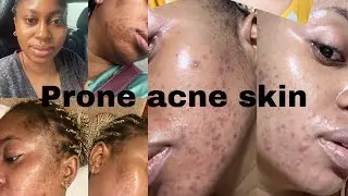 HOW I CLEAR MY ACNE IN 4  MONTHS | PRODUCT I USED IN MY DESCRIPTION | OLOLADE CREAMY