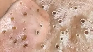 Deep Big Removal Of Blackheads, Ear, Nose