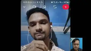 Sharing Experience - Beard Hair Transplant Failed due to Unprofessional Doctor | Face ruined