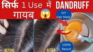 | सिर्फ 1 Use मे Dandruff गायब!😱 | Homemade Anti Dandruff Hair Mask | No Chemicals