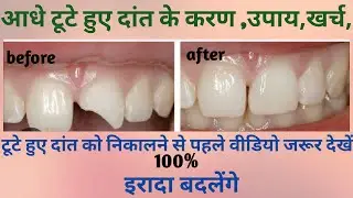 fractured tooth treatment/aadhe tute hue danto ka ilaaj