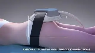 Emsculpt &mdash; for Non-Invasive Butt Lift