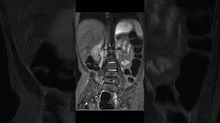 Myelomeningocele #radiology #mri #mritech #medicalimaging #spinemri