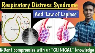 Respiratory Distress Syndrome || Law of Laplace || Respiratory Physiology|| hindi|| Ashish