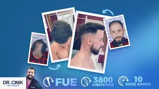 Témoignage greffe de cheveux FUE - Mickael | Transplantation de cheveux Dr.Cinik