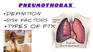 Pneumothorax Types & Risk Factors Explained | ICU & Medical Guide
