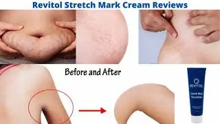 Revitol Stretch Mark Cream Review Stretch Mark Prevention Cream