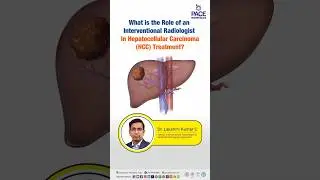 What is the Role of an Interventional Radiologist in HCC Treatment? | Liver Cancer Management