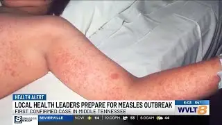 Health experts prepare for potential measles outbreak after first confirmed case in Tennessee