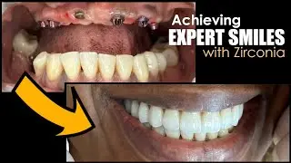 Achieving Expert Smiles with Zirconia