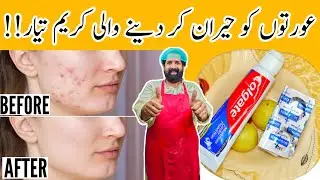 How To Remove Pimples Overnight | Acne Treatment | Remove Dark Spots |100% Effective | BaBa Food RRC