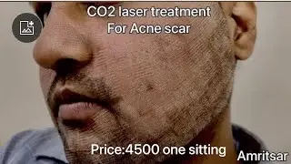 I got franctional CO2 Laser Treatment for Acne Scars | first sitting | Before After Results |