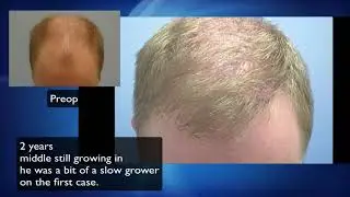 Another great hair transplant result in DC by Dr. Lindsey | McLean | Virginia | MD