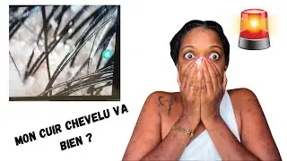 Mon cuir chevelu est en détresse après + de 30 ans de défrisage