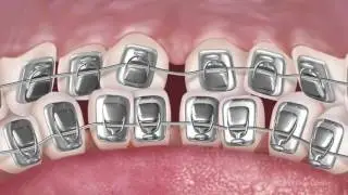 Adult Orthodontics - Educational Video