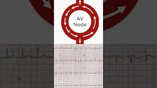 AVNRT ECG