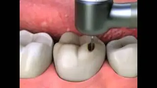 Resin Indirect Inlays or Onlays | Lake Merritt Dental, Oakland, CA
