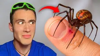 MORSO DALLA FALSA VEDOVA (Steatoda triangulosa) - non me l'aspettavo...