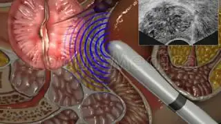 Transrectal biopsy - Animated Atlas of BPH and OAB