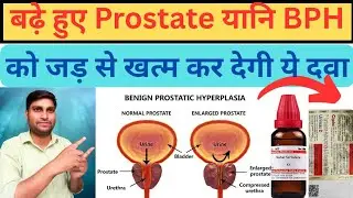 Enlarged Prostate(BPH) Explained: Symptoms, Causes and Treatment🔥