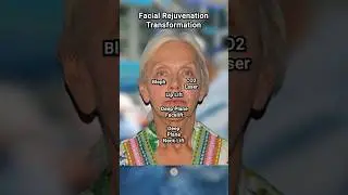 ONLY 7 Weeks Post-Op | Deep Plane Facial Rejuvenation #antiaging #cosmeticsurgery #lips #goviral